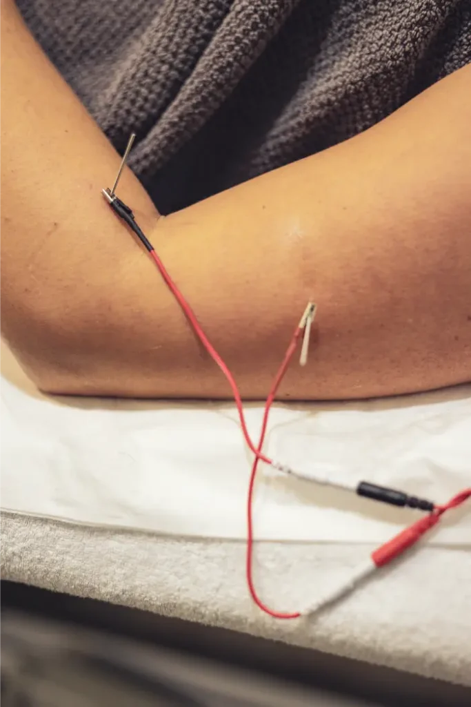 neuromodulacion ecoguiada algete fisioterapia avanzada